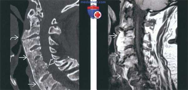 Рентгенограмма, КТ, МРТ при диффузном идиопатическом скелетном гиперостозе