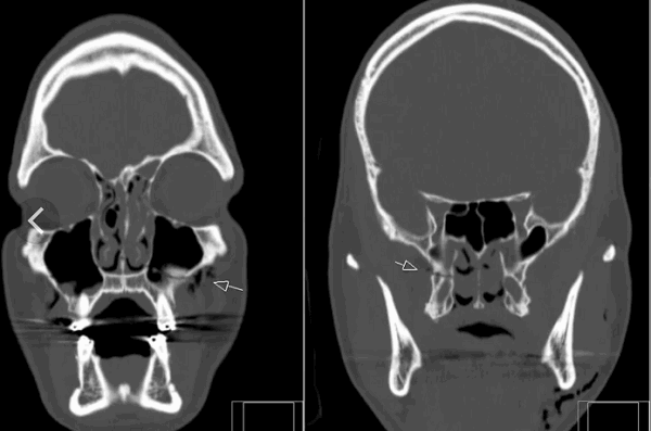 Что лучше при переломе: рентген или МРТ
