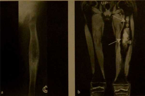 Снимки МРТ и КТ. Остеосаркома у детей