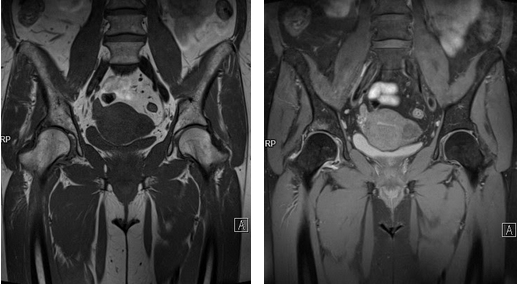 МРТ тазобедренного сустава