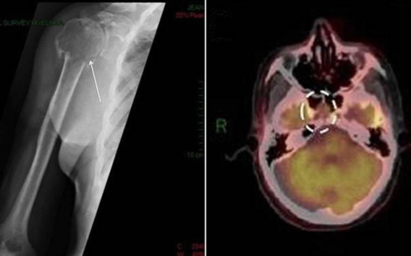 Плазмоцитома