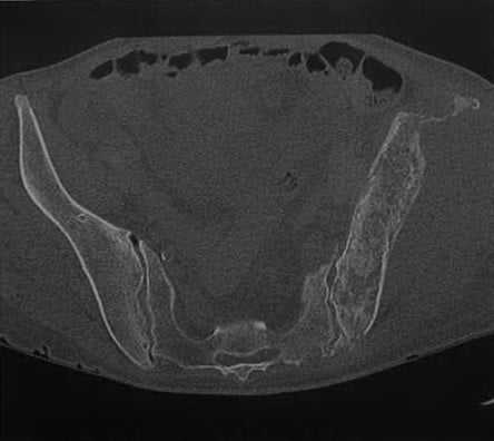 Снимки МРТ и КТ. Лимфома кости