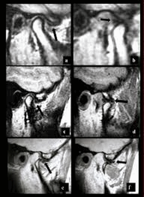 МР-изображение ВНЧС