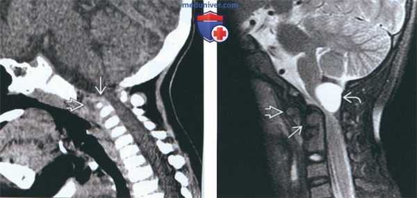 Лучевая диагностика аплазии, гипоплазии зубовидного отростка