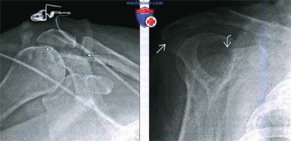 Рентгенограмма, КТ, МРТ при переломе лопатки