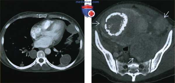 Лучевые признаки доброкачественной метастазирующей миомы