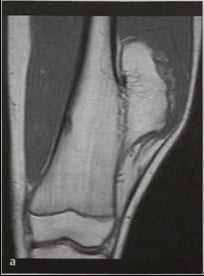 Снимки МРТ и КТ. Остеохондрома