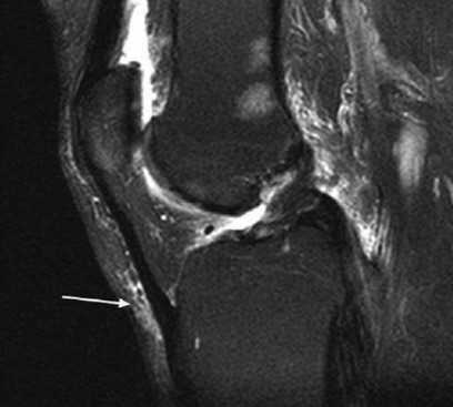 МРТ коленного сустава