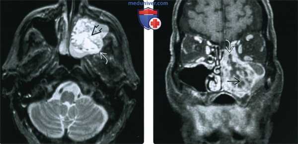 КТ, МРТ при амелобластоме