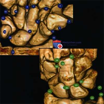 Мелкие, сесамовидные кости запястья и кисти