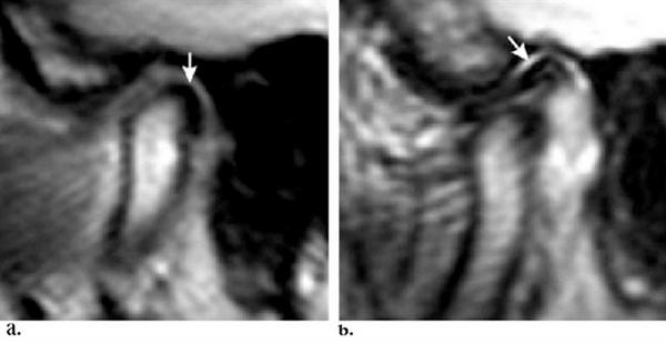 Застрявший диск на МРТ ВНЧС