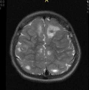 туберозный склероз2