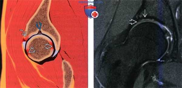 Рентгенограмма, КТ, МРТ при хрящевой и костно-хрящевой патологии тазобедренного сустава