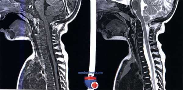 Рентгенограмма, МРТ позвоночника при остеопетрозе