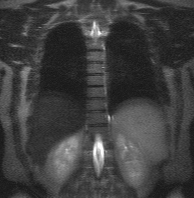 МРТ грудного отдела позвоночника