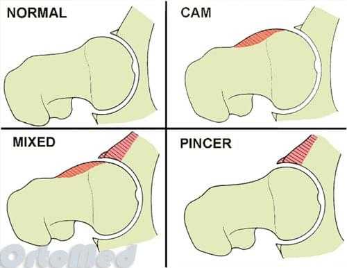 импинджмент - синдром