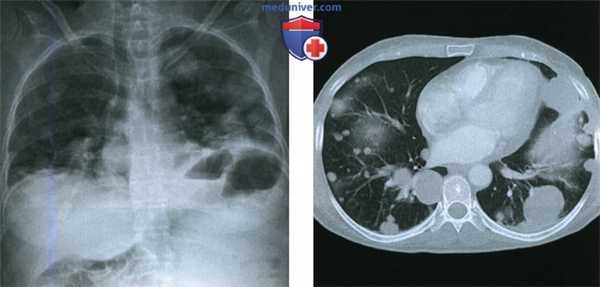 Лучевые признаки доброкачественной метастазирующей миомы