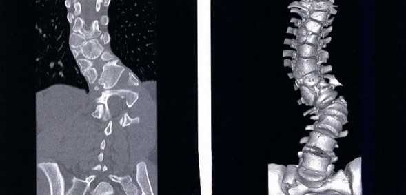 Сколиоз позвоночника на снимках КТ