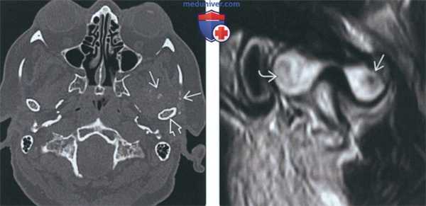 КТ, МРТ при первичном синовиальном хондроматозе височно-нижнечелюстного сустава (ВНЧС)