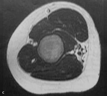 Снимки МРТ и КТ. Фиброзная дисплазия - болезнь Брайцева