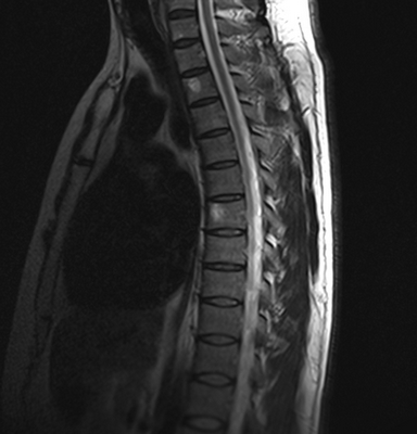 гемангиомы на МРТ грудного отдела позвоночника