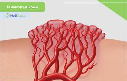 подкожная гемангиома у детей лечение