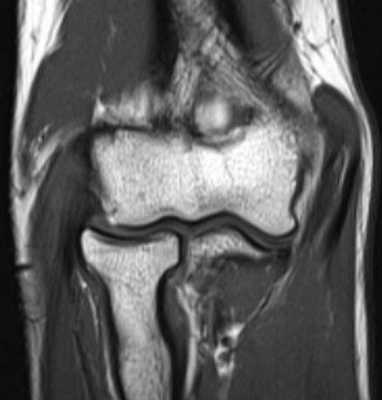 МРТ локтевого сустава в корональной плоскости