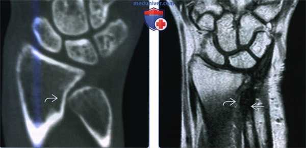 Признаки локтевого импиджмент-синдрома