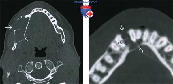 КТ, МРТ при амелобластоме
