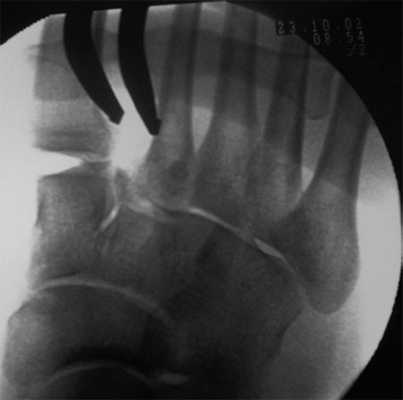 вывих Лисфранка