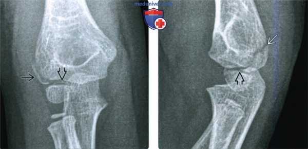 Рентгенограмма, КТ, МРТ, УЗИ при переломе латерального мыщелка локтевого сустава