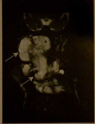 Снимки МРТ и КТ. Лимфангиома у детей