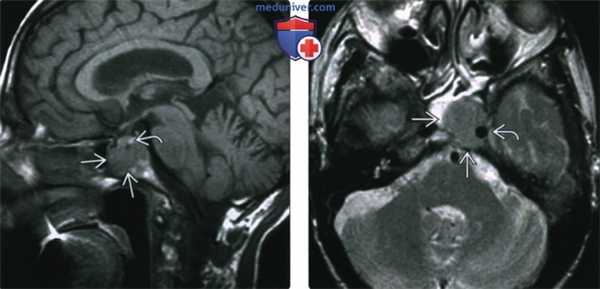 КТ, МРТ при плазмоцитоме основания черепа
