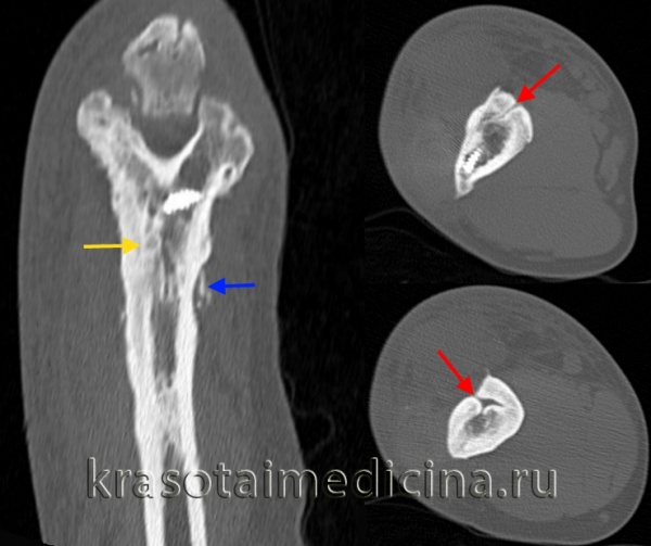КТ локтевого сустава. Утолщение кортикального слоя плечевой кости за счет гиперостоза/остеосклероза (желтая стрелка), периостальные наложения (синяя стрелка), свищевые ходы (красная стрелка).