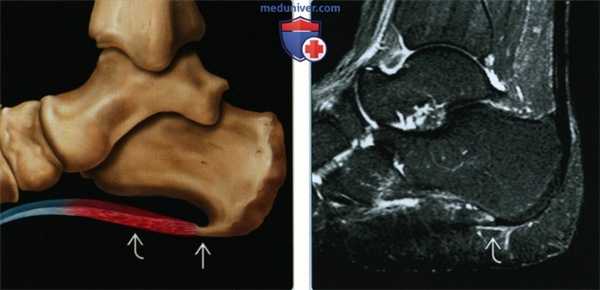 Признаки подошвенного фасциита