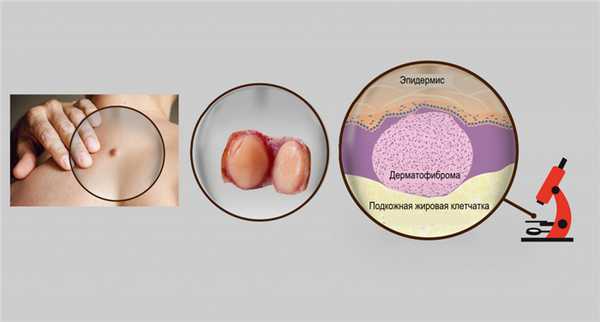 Фиброма кожи.jpg