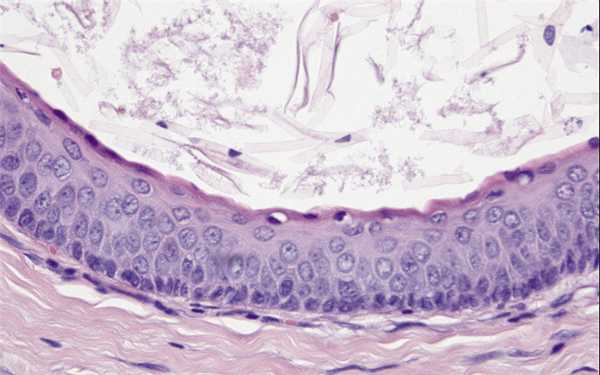 Рис. 3. Фрагмент исследуемого гистологического препарата (окраска гематоксилином и эозином, оригинальное увеличение в 40 раз): равномерно структурированный эпителий с ороговением по типу паракератоза. Расположение клеток базального слоя напоминает частокол («палисадное»), отмечается интенсивное окрашивание клеточных ядер. В полости кисты определяется скопление пластинчатого ороговевшего материала.