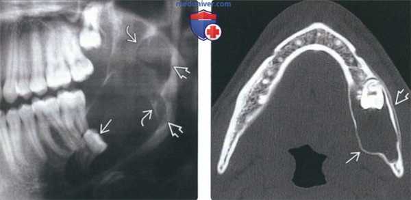 Рентгенограмма, КТ, МРТ при одонтогенной кератокисте