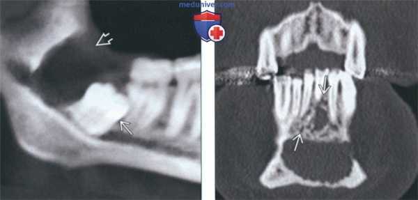 Рентгенограмма, КТ, МРТ при амелобластоме челюсти