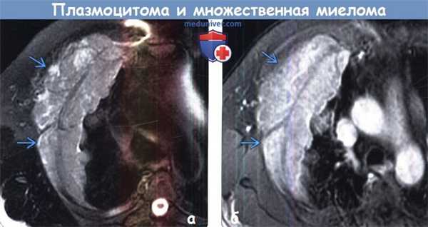 Плазмоцитома и множественная миелома на МРТ органов грудной клетки