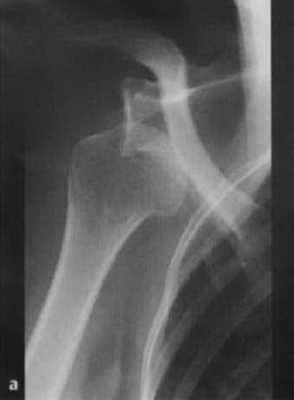 Снимки МРТ и КТ. Вывих плечевого сустава