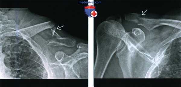 Признаки перелома ключицы