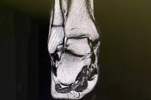 МРТ голеностопного сустава в корональной плоскости