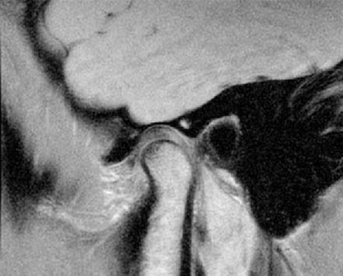 Норма ВНЧС на МРТ