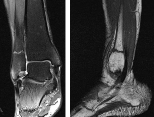 Показывает ли МРТ перелом костей