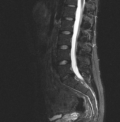 грыжа на МРТ