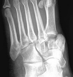 Рентгенограмма при вывихе в суставе Лисфранка