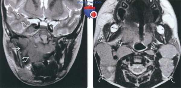 Рентгенограмма, КТ, МРТ при лимфоме Беркитта челюсти