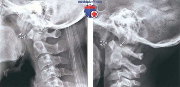 Лучевая диагностика аплазии, гипоплазии зубовидного отростка