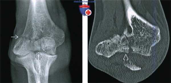 Рентгенограмма, КТ, МРТ, УЗИ при переломе латерального мыщелка локтевого сустава